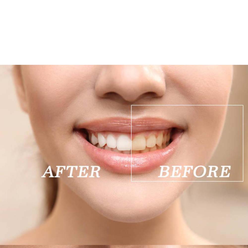 歯のホワイトニングキット,高品質の製品,過酸化物,明るい白, - Teeth Whitening Kit With Light のレビューと価格
