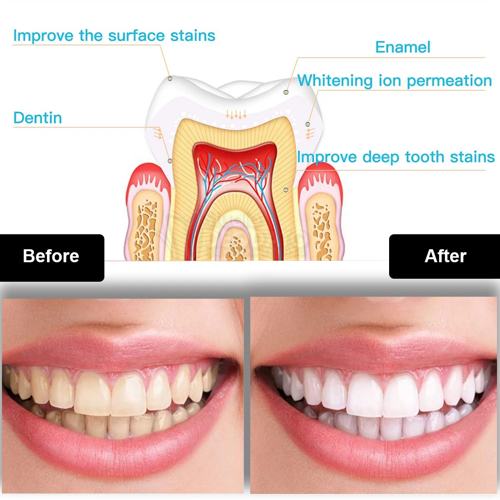 歯科歯ホワイトニングキットミニ 16 LED コールドライト - Teeth Whitening Kit With Light のレビューと価格