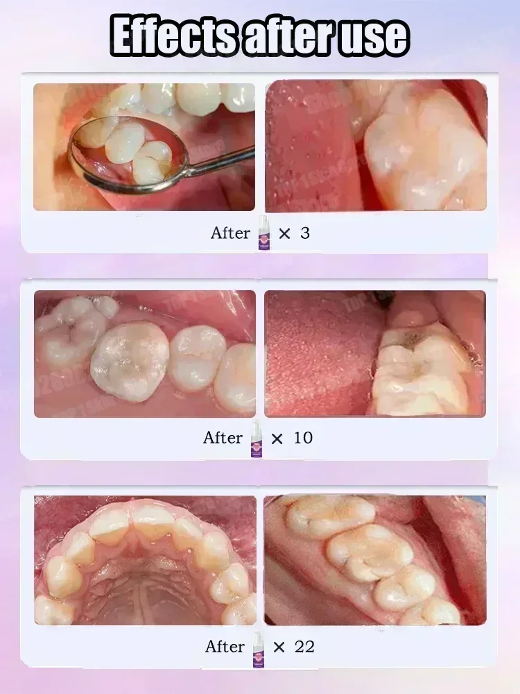 ホットセールのベストセラー、科学的修復虫歯、虫歯の除去、歯垢 - Teeth Whitening Cream のレビューと価格