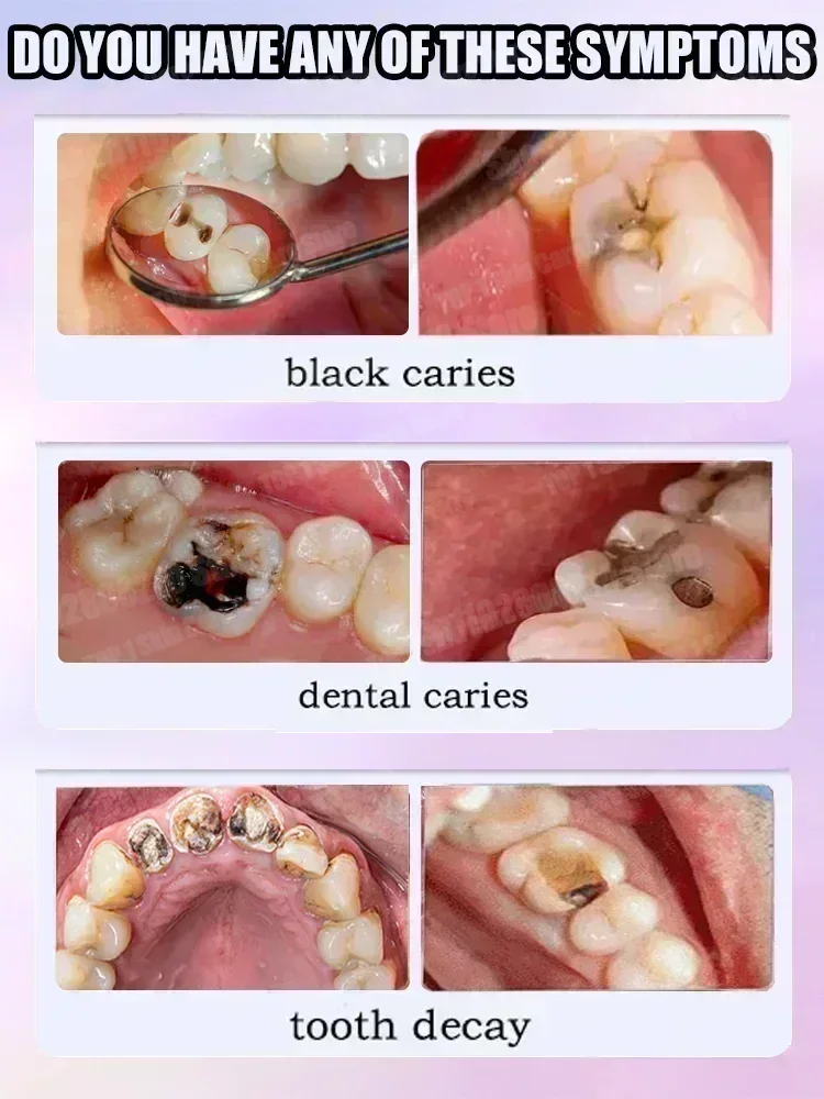 ホットセールのベストセラー、科学的修復虫歯、虫歯の除去、歯垢 - Teeth Whitening Cream のレビューと価格